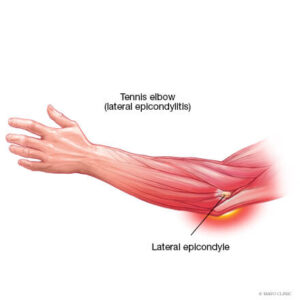 Read more about the article All about the aching elbow!