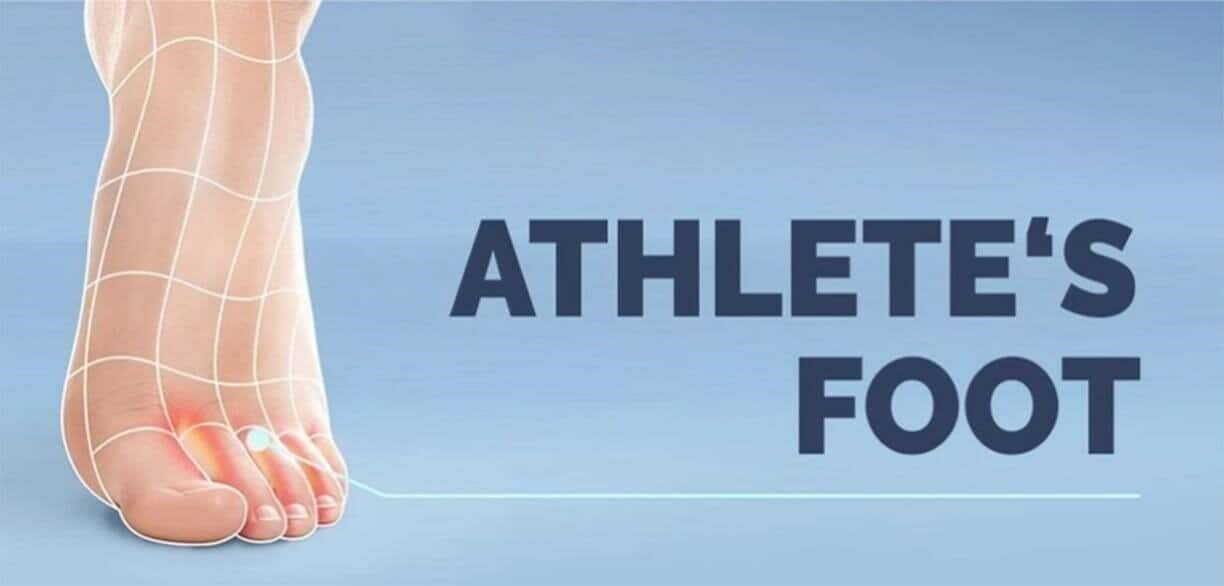 Read more about the article All about the Athletic Foot