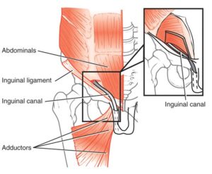 Read more about the article Simplifying Sports Hernia