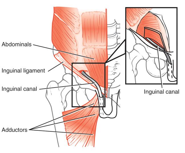 You are currently viewing Simplifying Sports Hernia