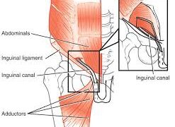 Sports Hernia on the Rise: Why Athletes Must Pay Attention Now