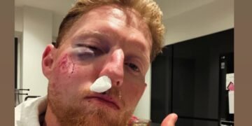 Ben Stokes Left Bloodied After Net Session Mishap